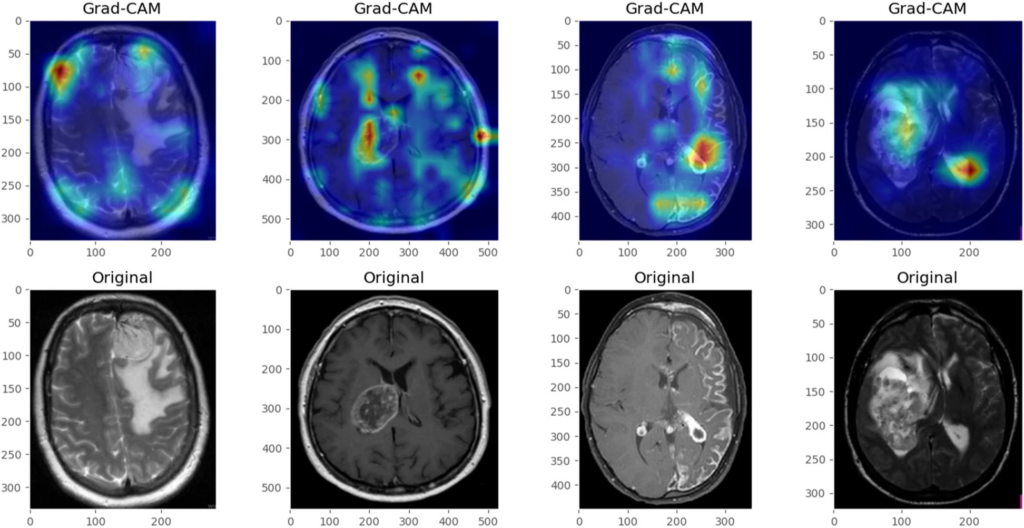 Grad-CAM visualization showing the areas of the brain that have contributed to positive tumor diagnosis