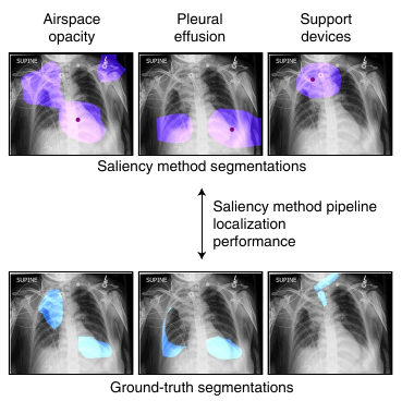 Saliency maps obtained from explanations vs segmentations drawn by expert radiologists. A large overlap suggests an explanation method provides useful information for understanding a diagnosis (source: [2]).