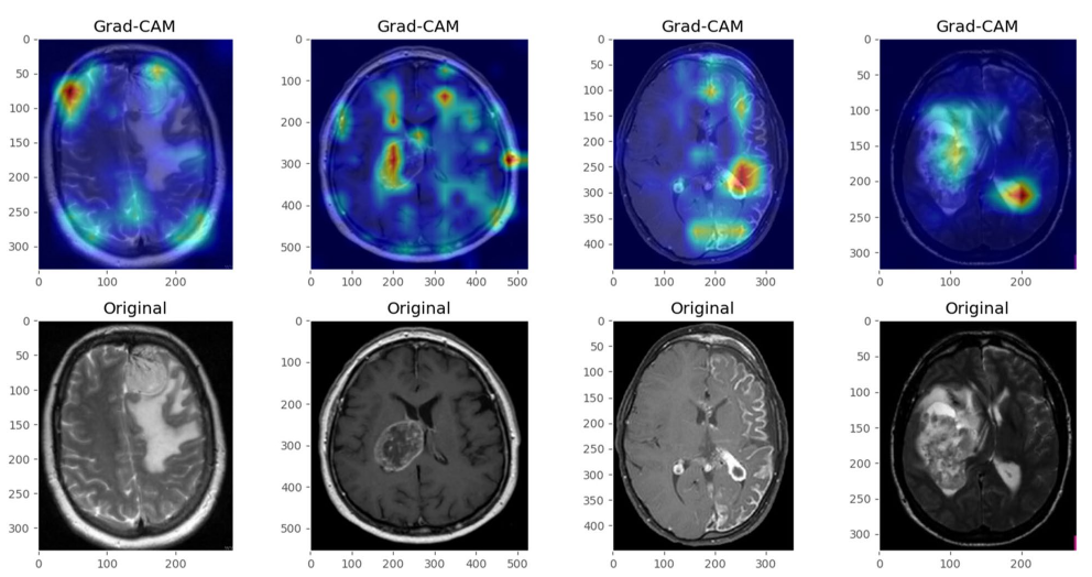 Grad-CAM visualisation showing the areas of the brain that have contributed to positive tumour diagnosis (source: [5]).